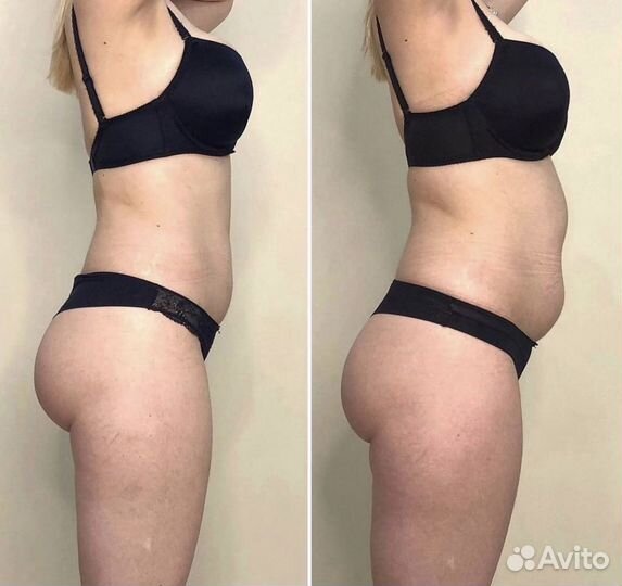 Аппаратная липосакция, liposfera