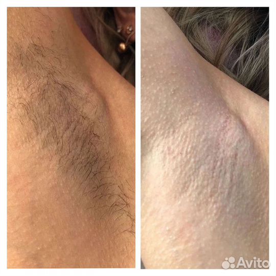 Электроэпиляция: бёдра