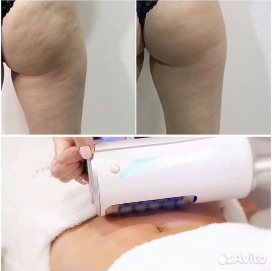 Массаж эндосфера