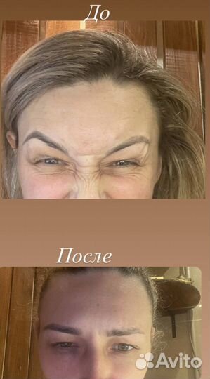 Мезотерапия волос