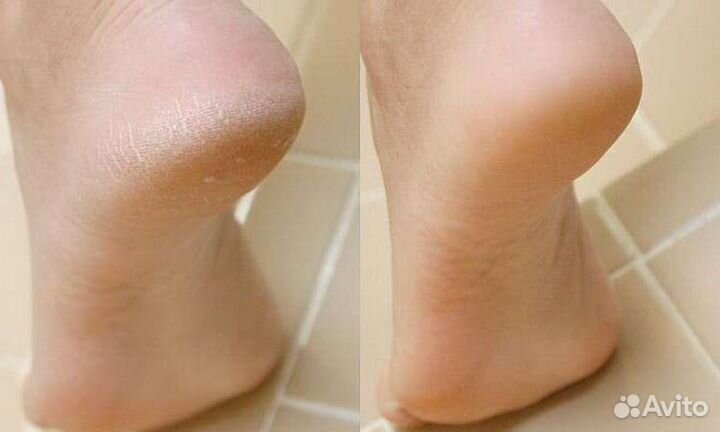 Педикюр на дому