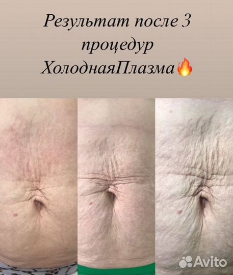 Плазменное омоложение. Холодная плазма