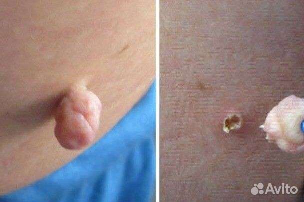 Удаление папиллом,родинок,бородавок