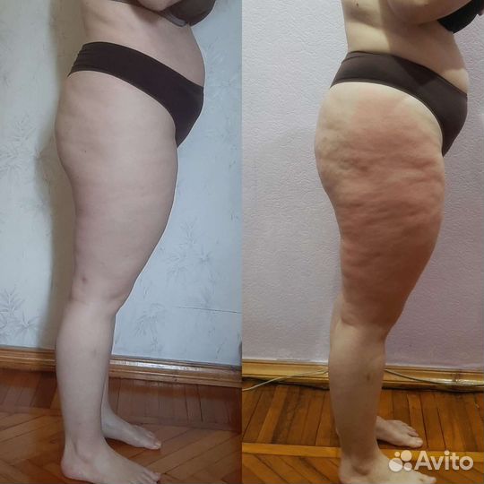Антицеллюлитный массаж