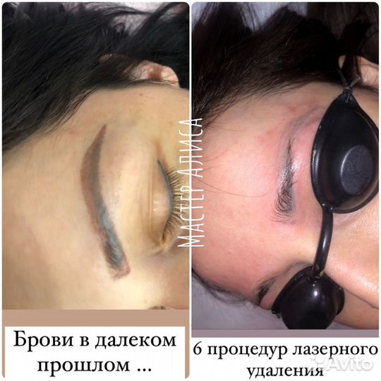 Лазерное удаление татуажа и тату