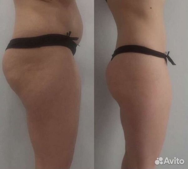 Аппаратный массаж коррекция фигуры