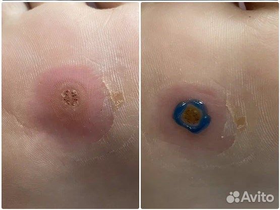 Удаление бородавок на стопах, подолог