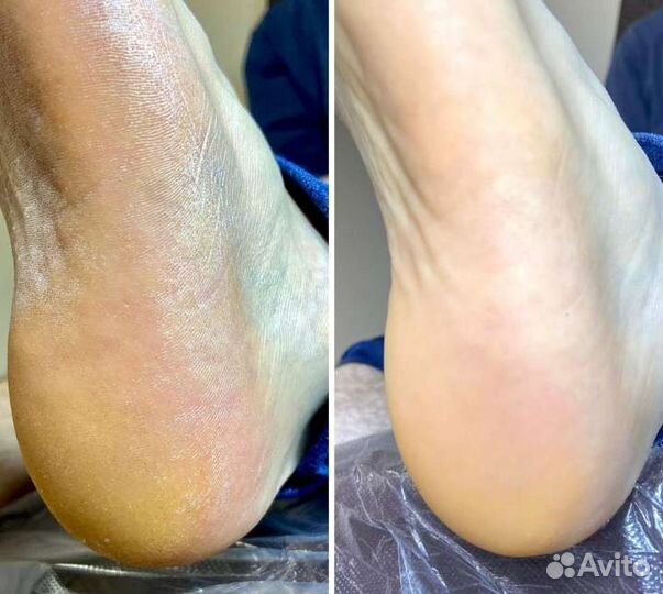 Подолог, педикюр смарт