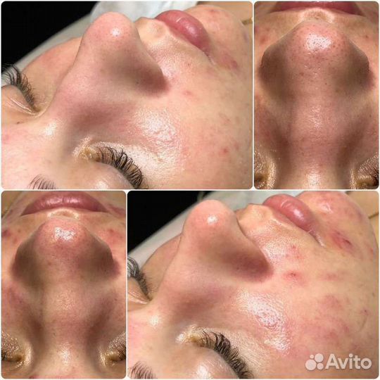 Косметология, контурная пластика