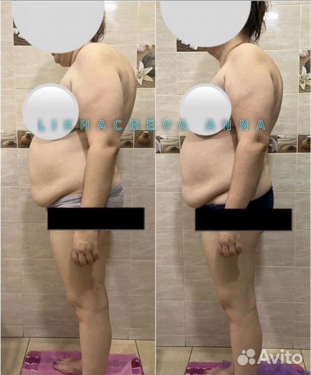 Остеопластика - мягкая правка тела и лица