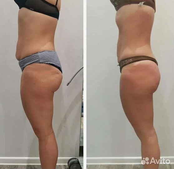 Карамельная липосакция