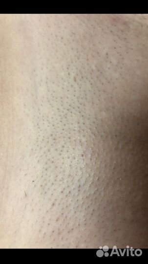 Лазерная эпиляция