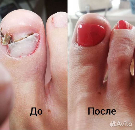 Коррекция вросшего ногтя Подолог