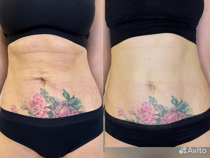 RF-лифтинг (подтяжка)