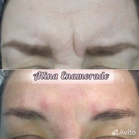 Нужны модели на ботокс