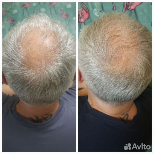 Спрей от выпадения волос Атоми Корея