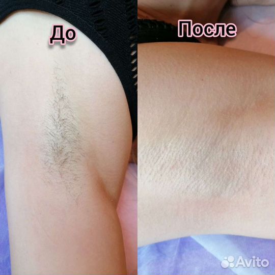 Депиляция Новогорелово Ветеранов