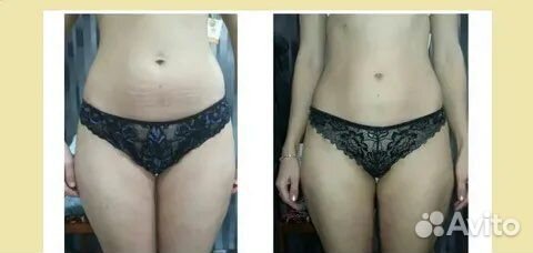 Антицеллюлитный массаж