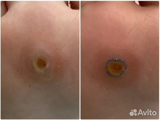 Удаление стержневых мозолей, подолог