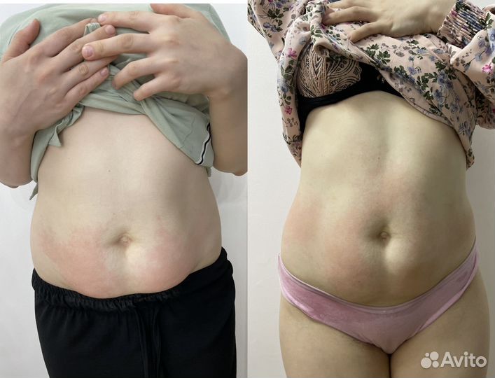 Массаж аппаратный антицеллюлитный