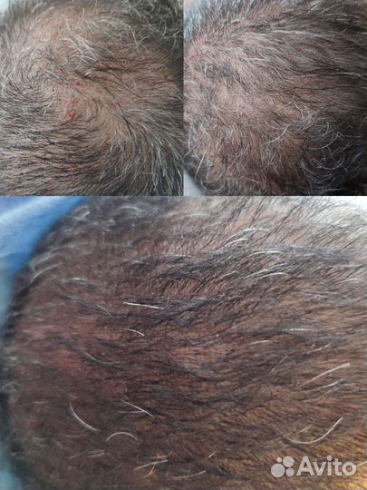 Плазмофиллинг, Плазмотерапия, Мезо, Чистка, Пилинг