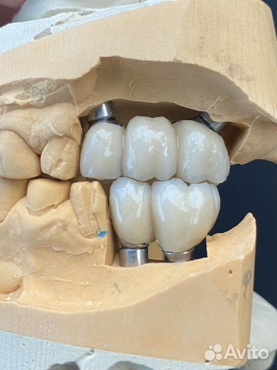 Коронки зубные изготовление