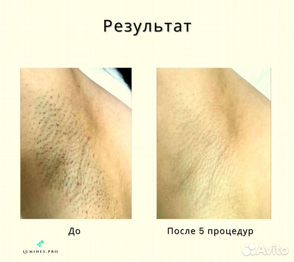 Диодный лазер для эпиляции Lumines Макс-Плюс 2000в