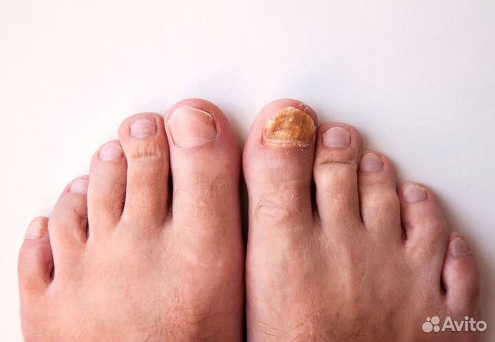 Медицинский педикюр подолог