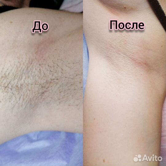 Депиляция Новогорелово Ветеранов