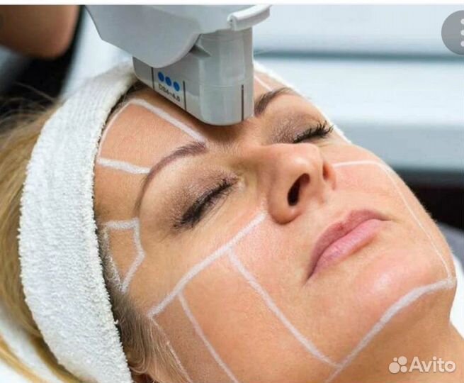 СМАС лифтинг