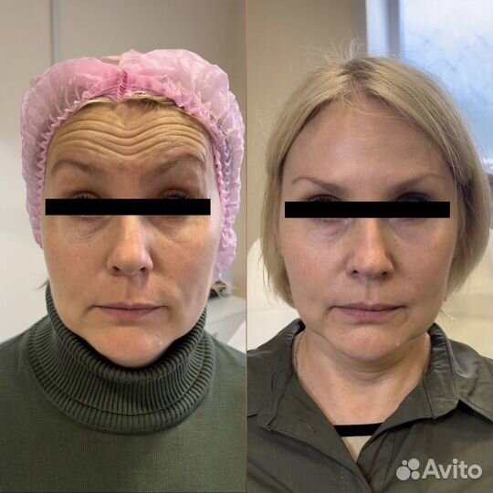 Ботулинотерапия, ботулотоксин, диспорт, релатокс