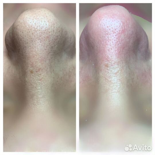 Чистка лица + Пилинг