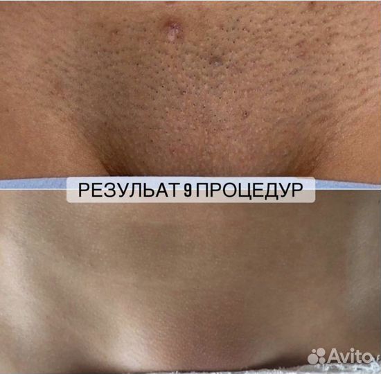 Лазерная эпиляция: глубокое бикини