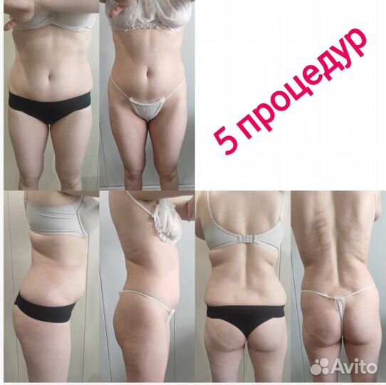 Спа, коррекция фигуры, эндосфера