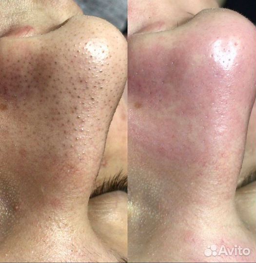 Массажи лица, чистки лица,перманентный макияж