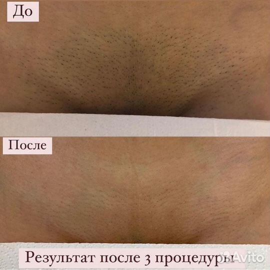 Лазерная эпиляция
