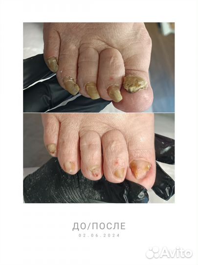 Аппаратный педикюр