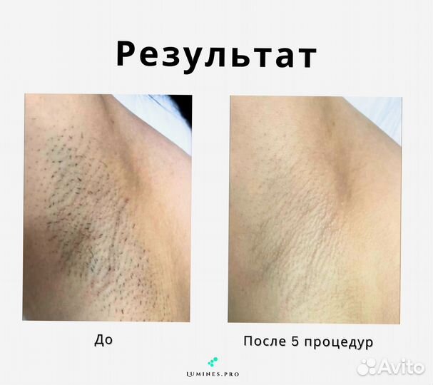 Диодный лазер для эпиляции Люминес. Max’One 1200в