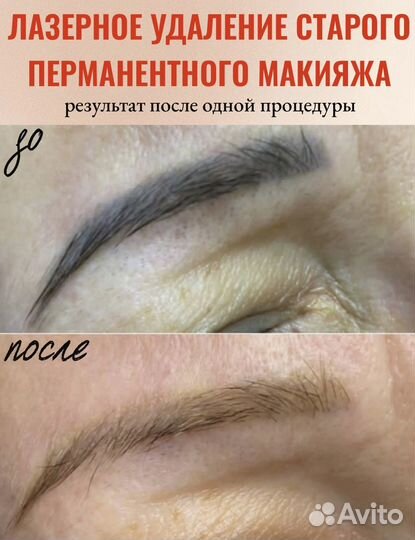 Лазерное удаление старого пм и татуировок