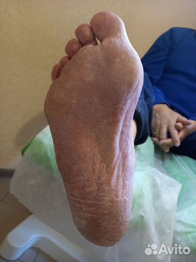 Медицинский педикюр