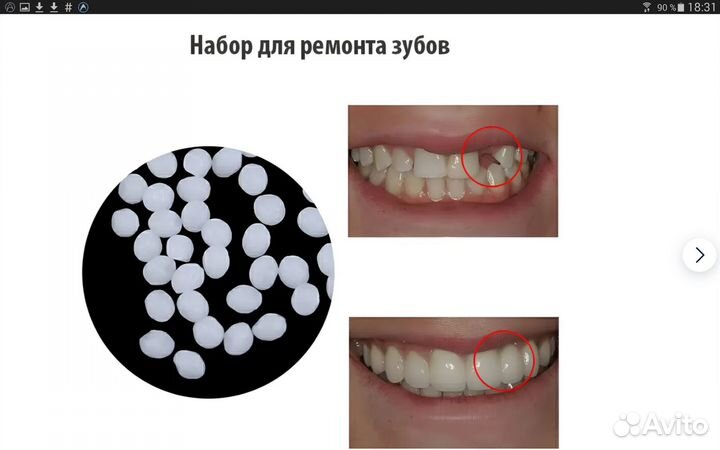 Домашний временный зуб или винир накладной