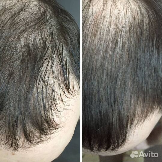 Восстановление и увеличение роста волос