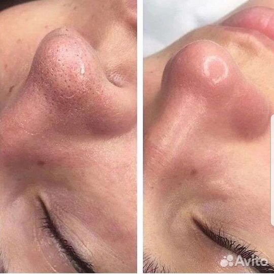 Косметолог Чистка лица Пилинг Биорепил