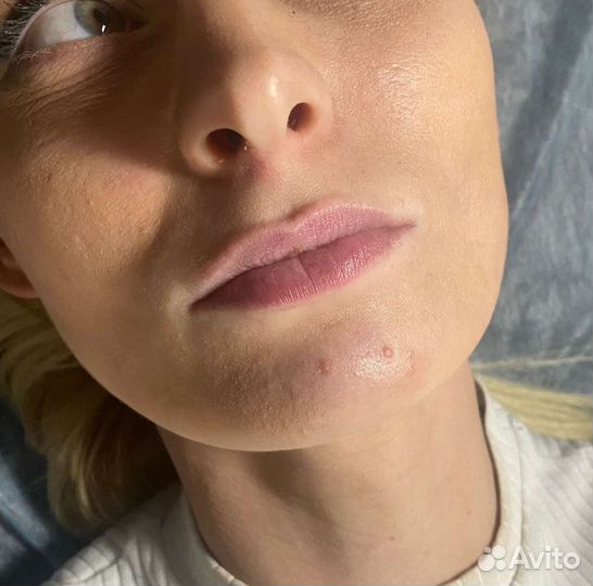 Увеличение губ