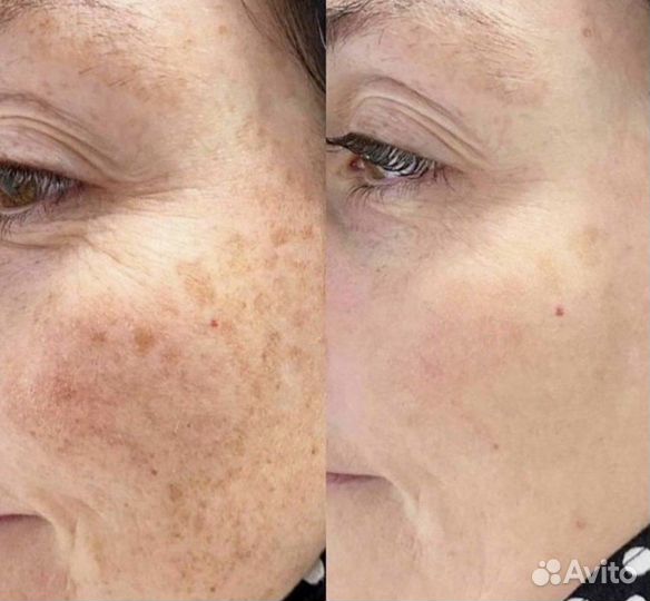 Удаление пигментных пятен