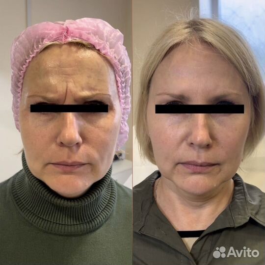 Ботулинотерапия, ботулотоксин, диспорт, релатокс