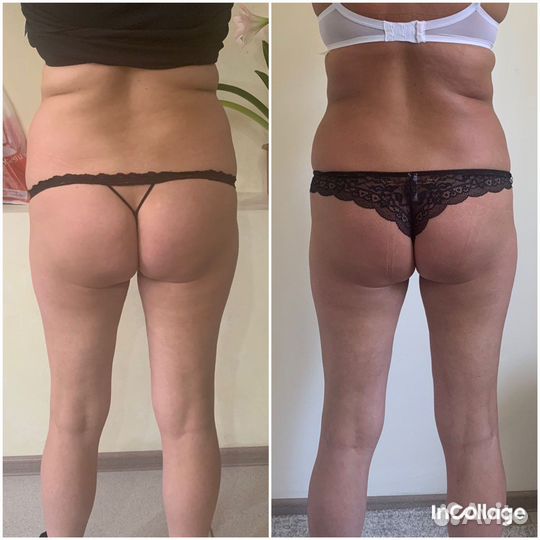 Лпдж массаж