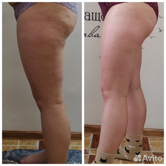 Аппаратный массаж