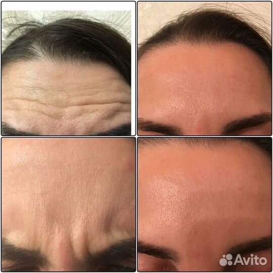 Ботокс лица
