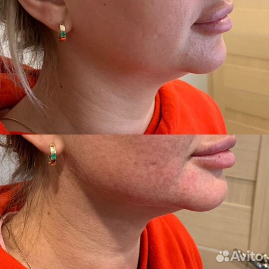 Холодная плазма